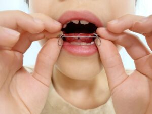 小児矯正 治療方法