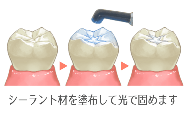 シーラントで虫歯のできやすい溝を埋める