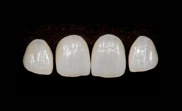 ラミネートベニア