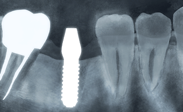 レントゲンで見たインプラント
