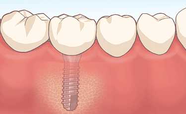 インプラントとは