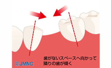 抜けてしまった歯のスペースに歯が傾く