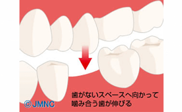 抜けてしまった歯のスペースにかみ合う歯が伸びてくる