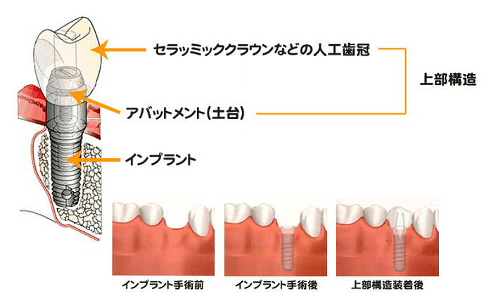インプラントの構造